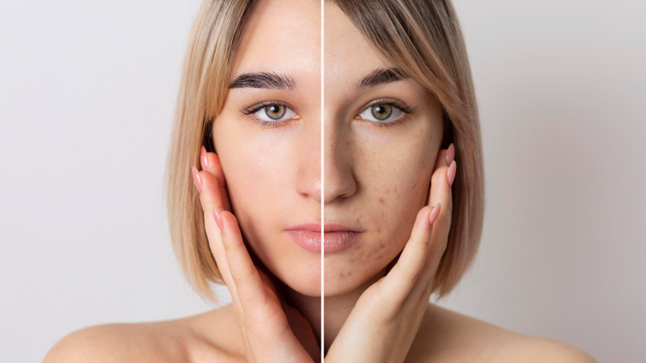 How to get clear, acne-free skin in your 20s. Pic Credit: Freepik