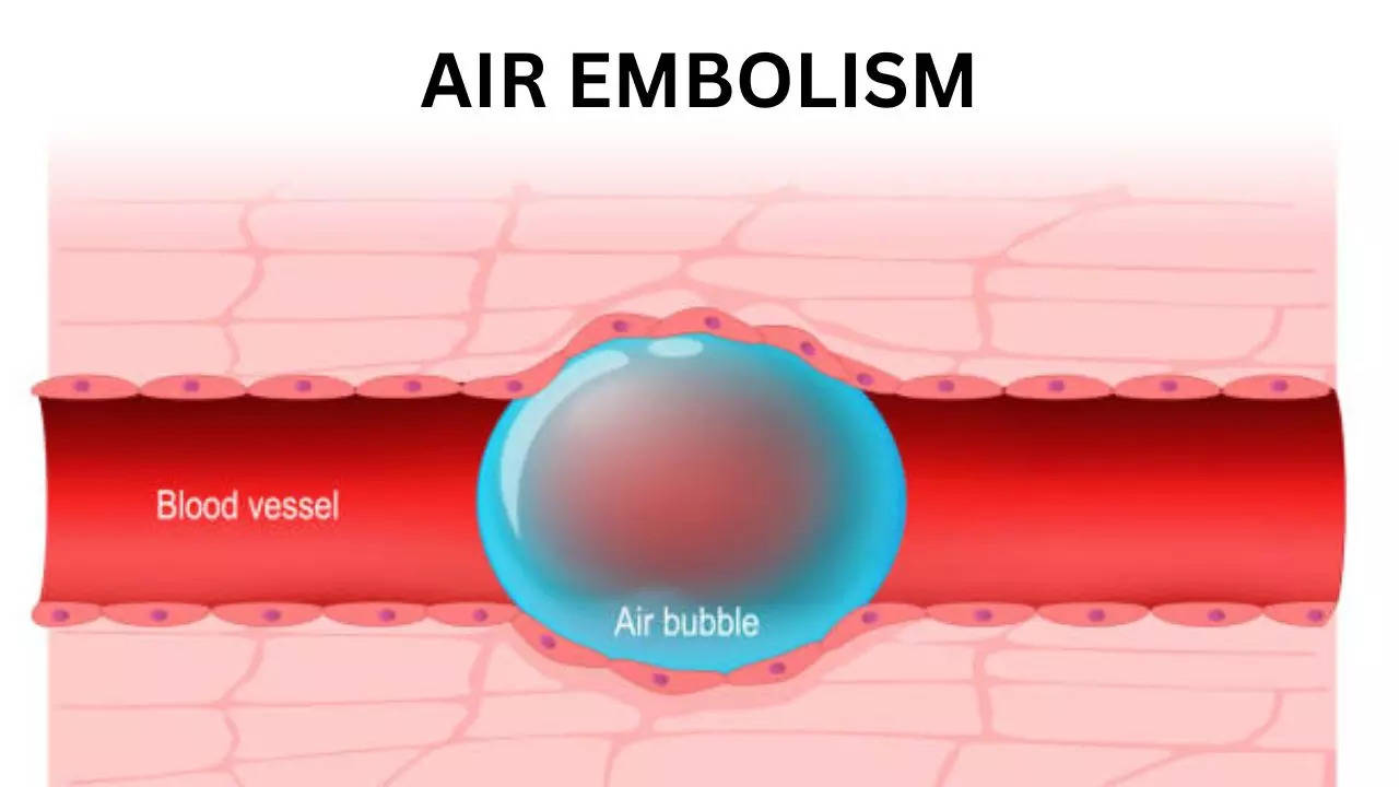 Air Embolism