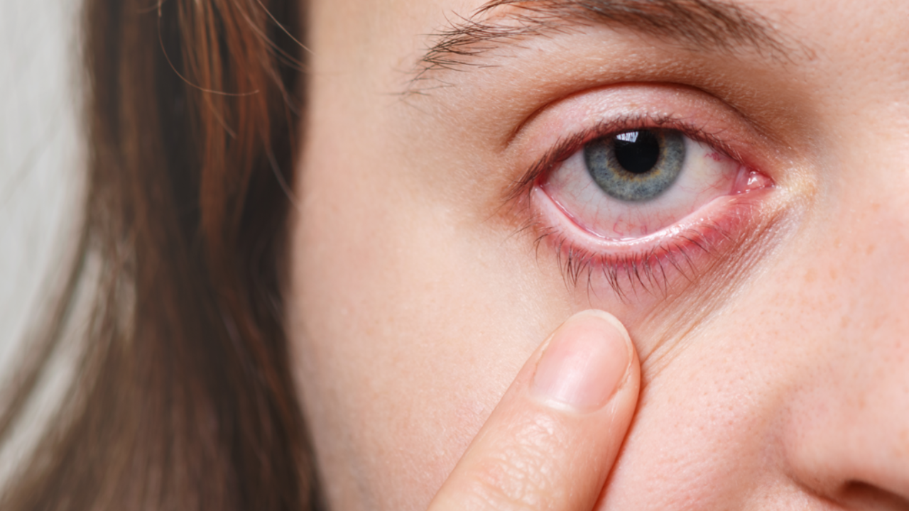 Ayurvedic Hacks For Conjunctivitis. Pic Credit: Freepik