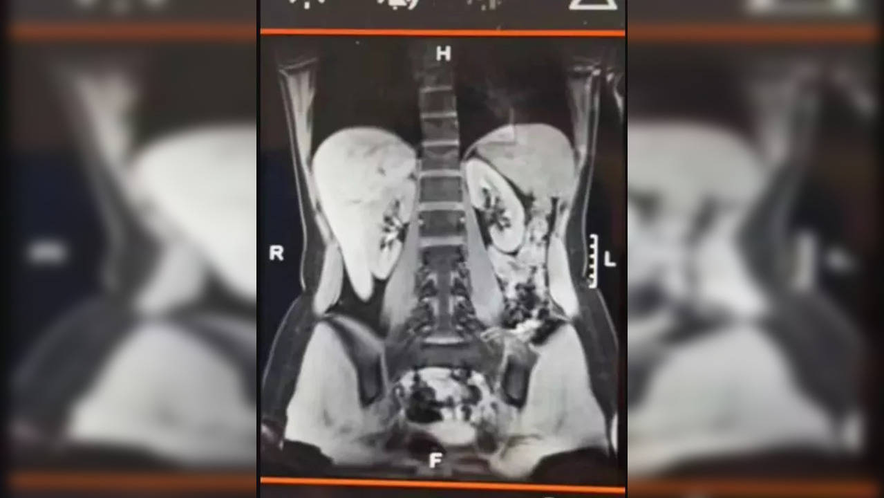 adenomas