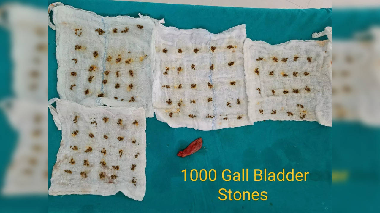 gallstones