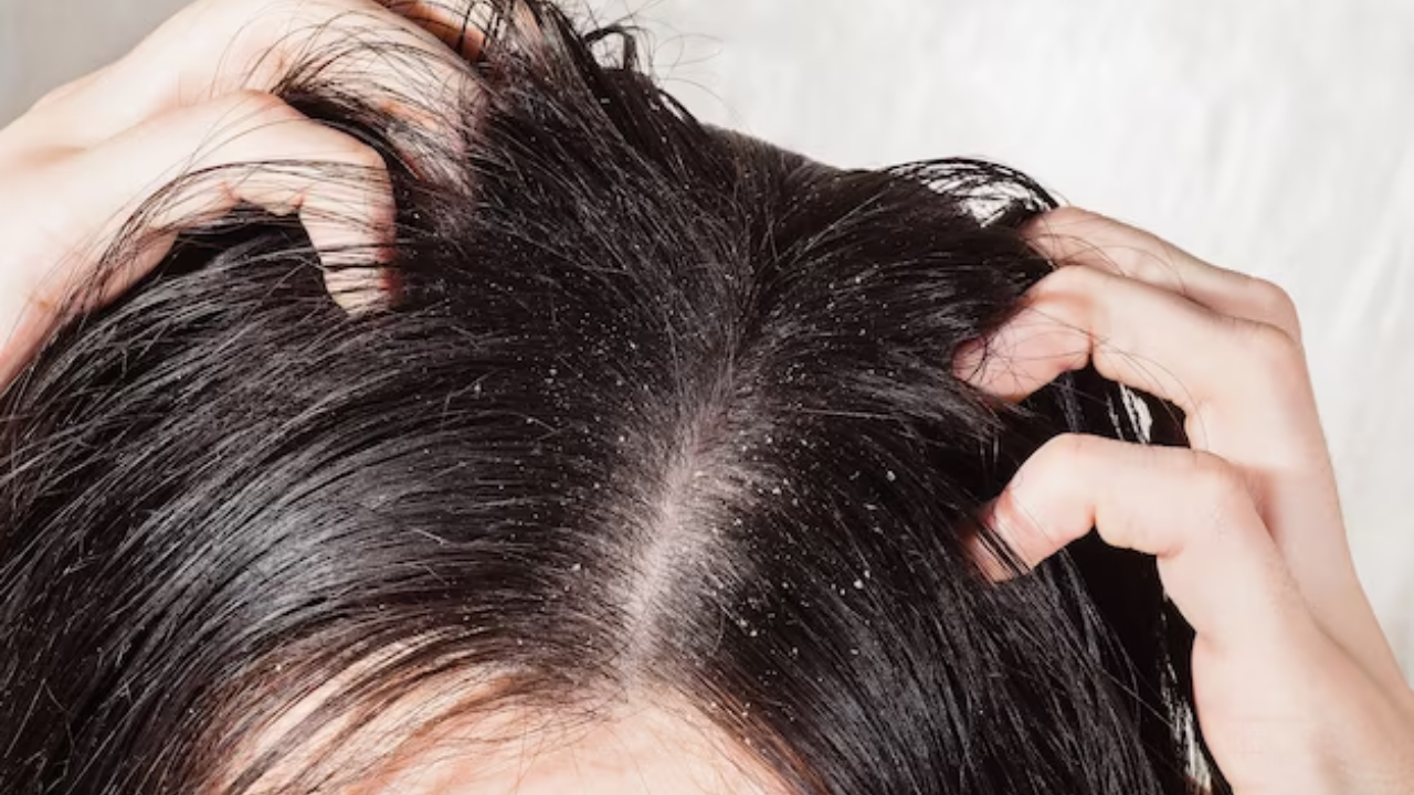 Ayurvedic Cure for Dandruff