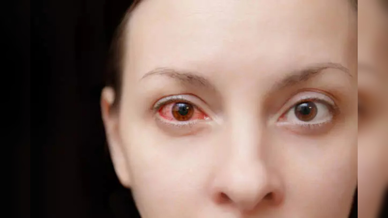 conjunctivitis