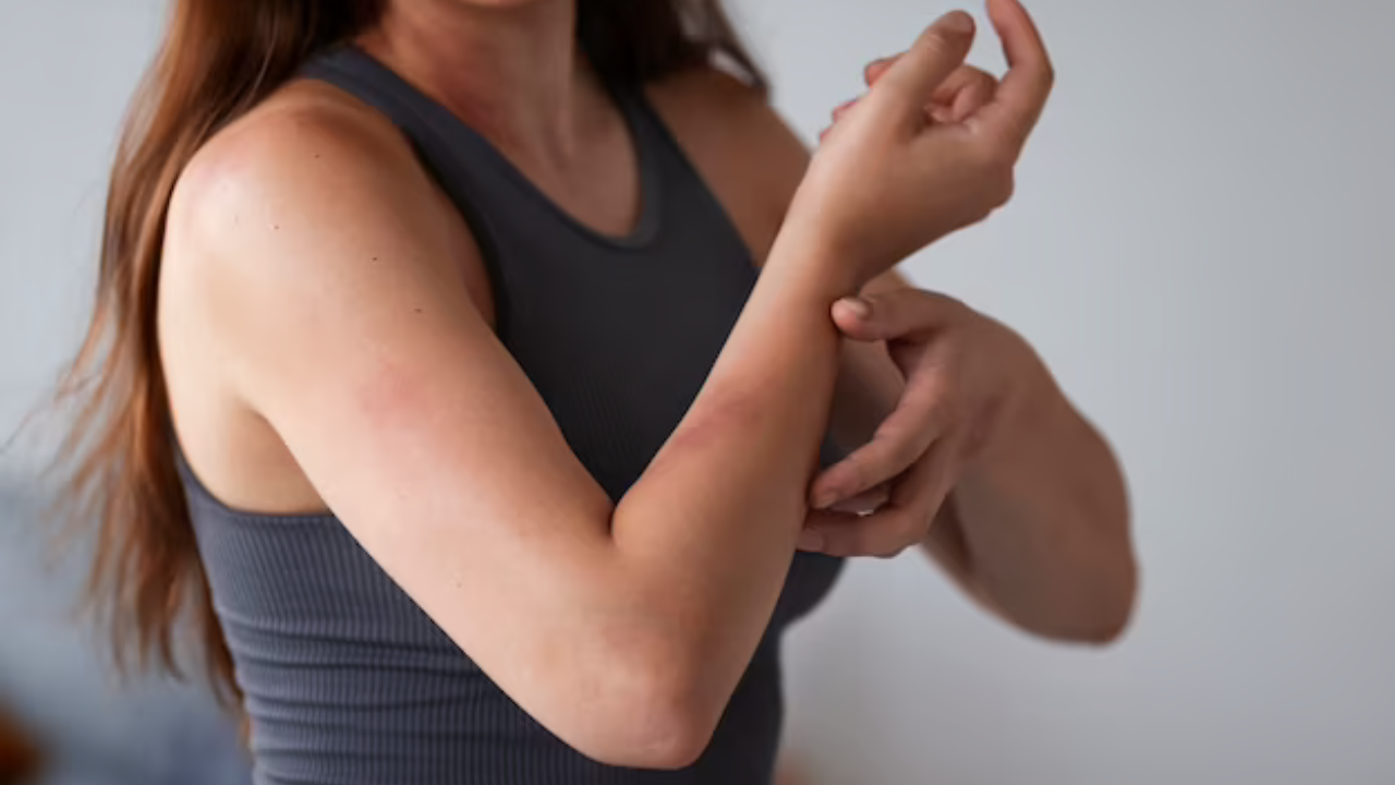 Mosquito Bite Rashes