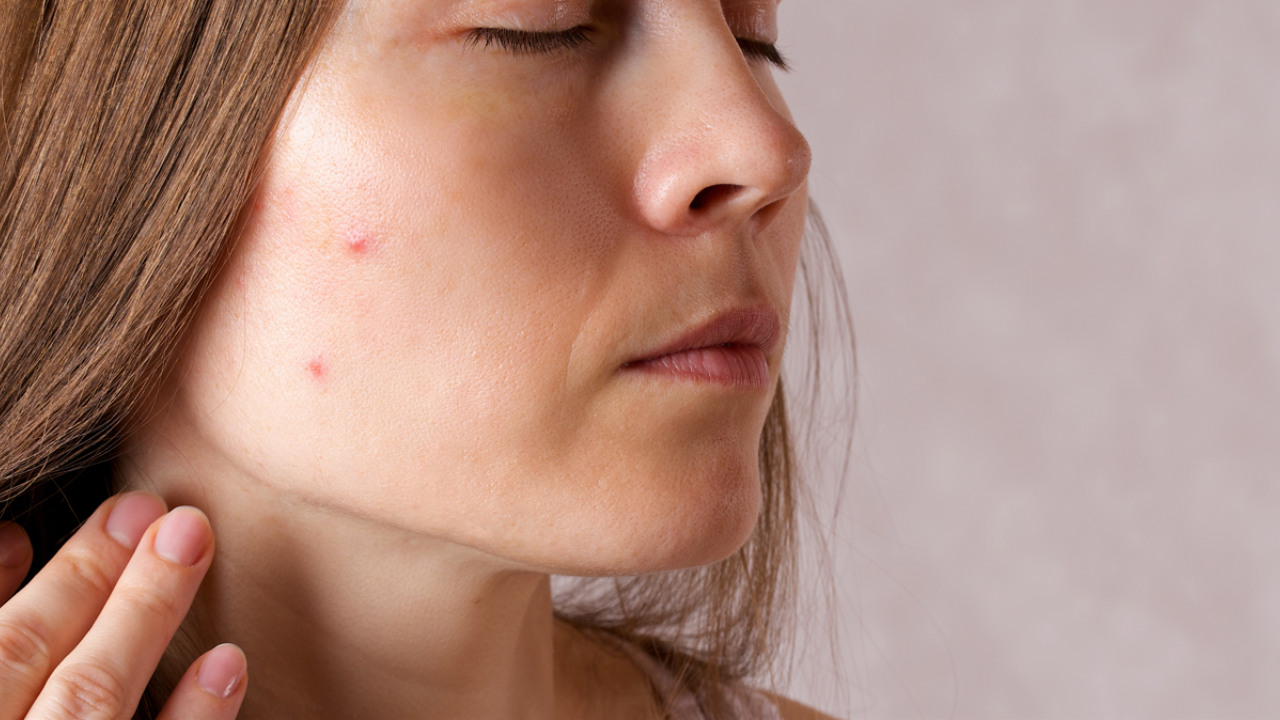 Ayurvedic home remedies for acne and other blemishes. Pic Credit: Vecteezy