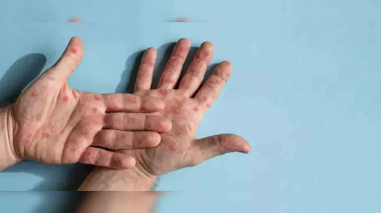 Hand, foot and mouth disease - NHS