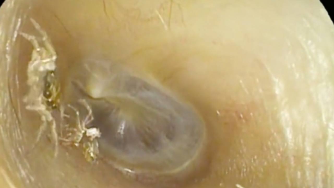 Woman Complains Of 'Buzzing' Sound In Ear, Doctors Find Spider Inside.