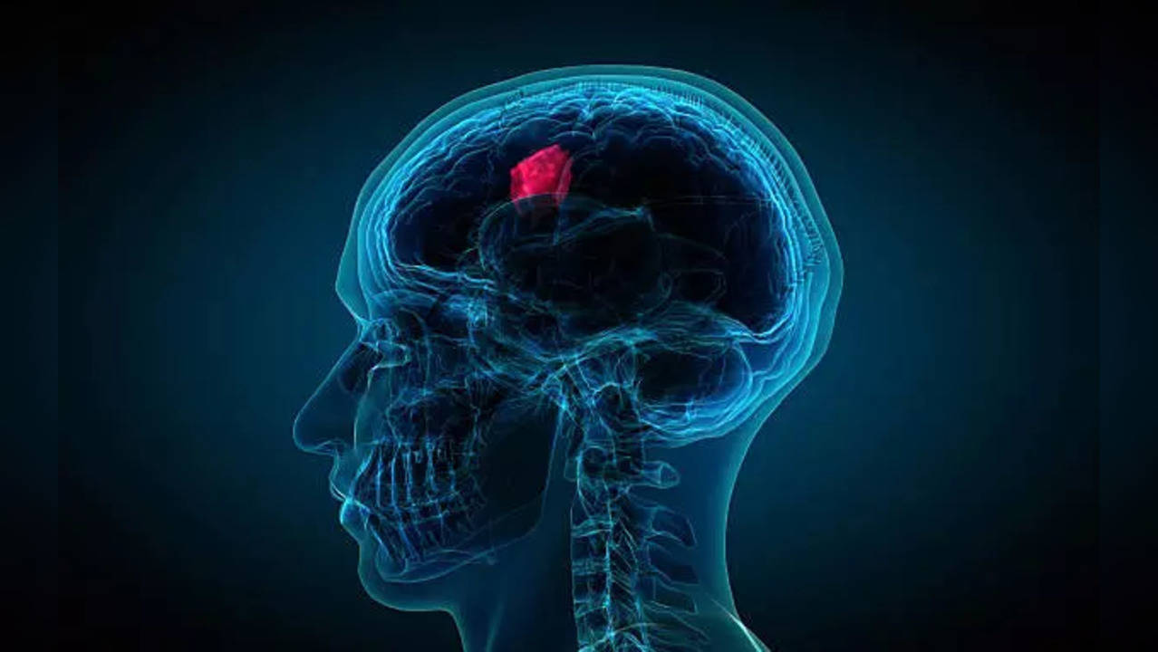 brain tumour