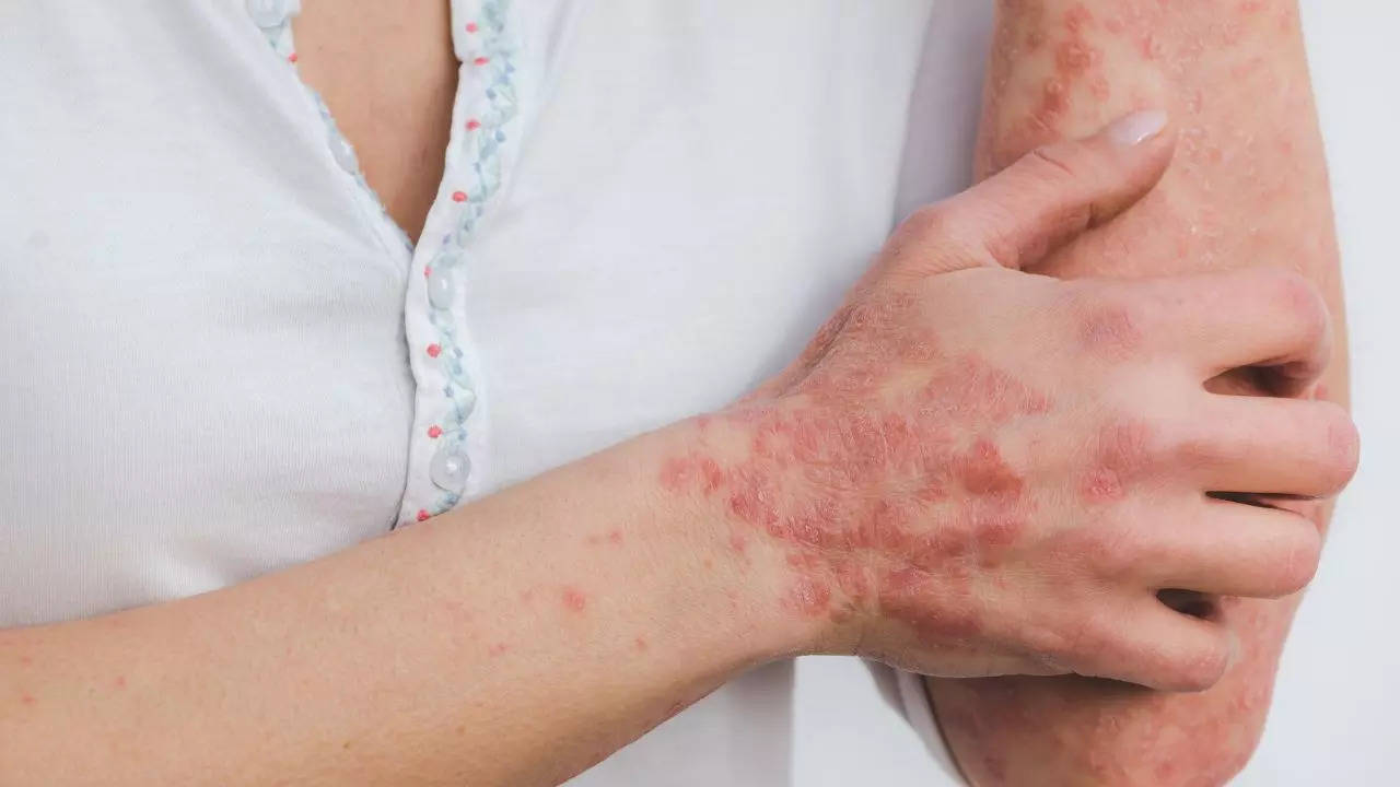 Psoriasis