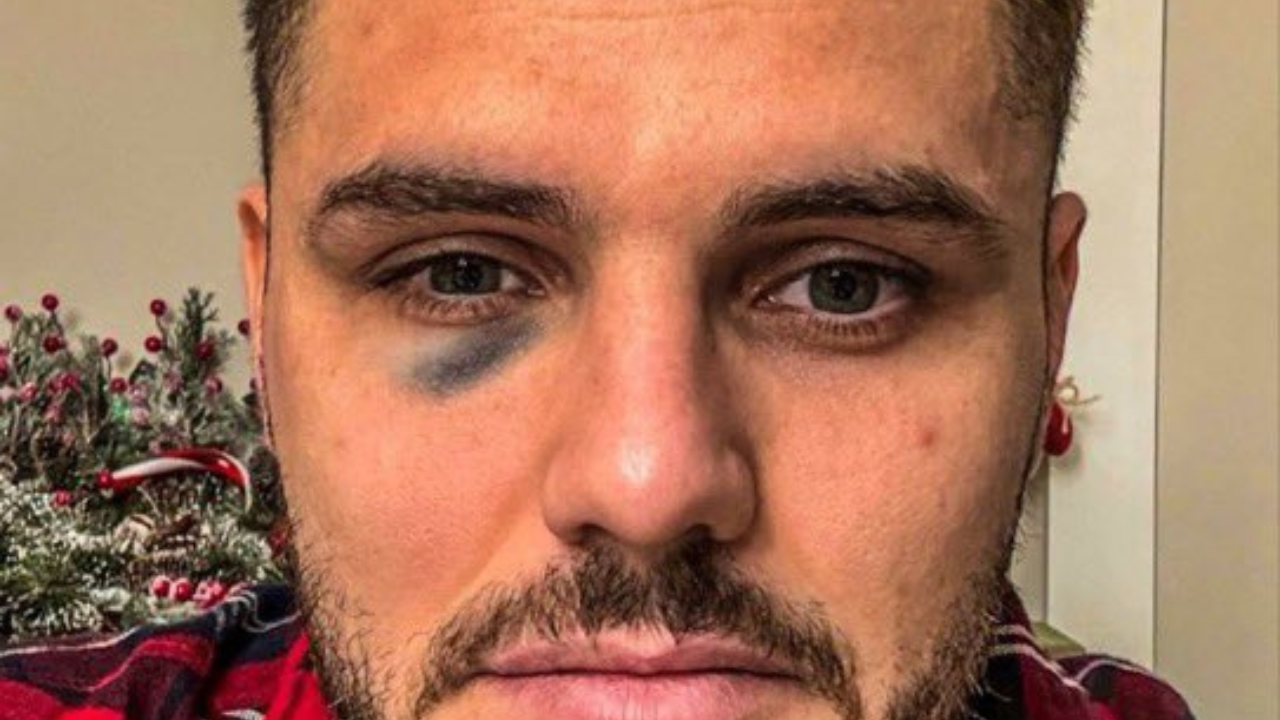 Mauro Icardi's 'Black Eye' Post