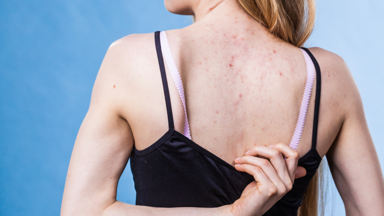 How to get rid of back acne