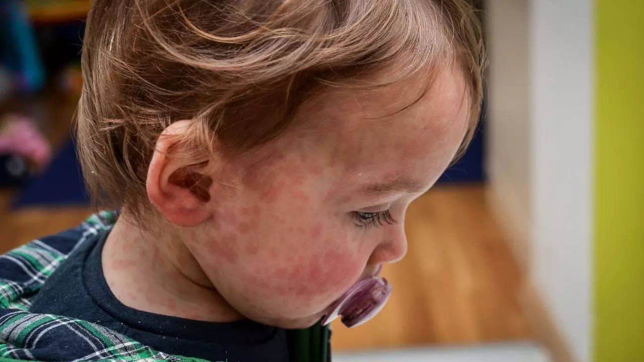 Measles outbreak in UK