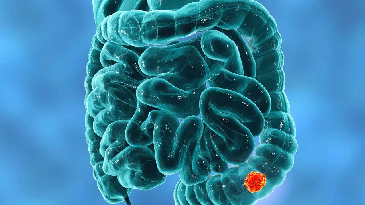Possible Signs of Colorectal Cancer in Younger Adults - NCI