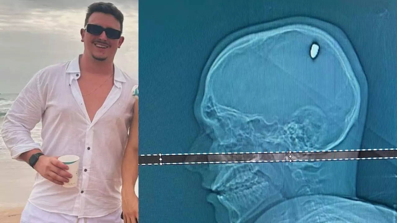 Who Is Mateus Facio? Brazilian Student Parties 4 Days With 9MM Bullet Inside His Brain