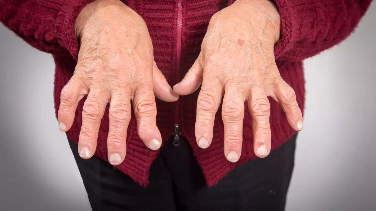 Rheumatoid arthritis