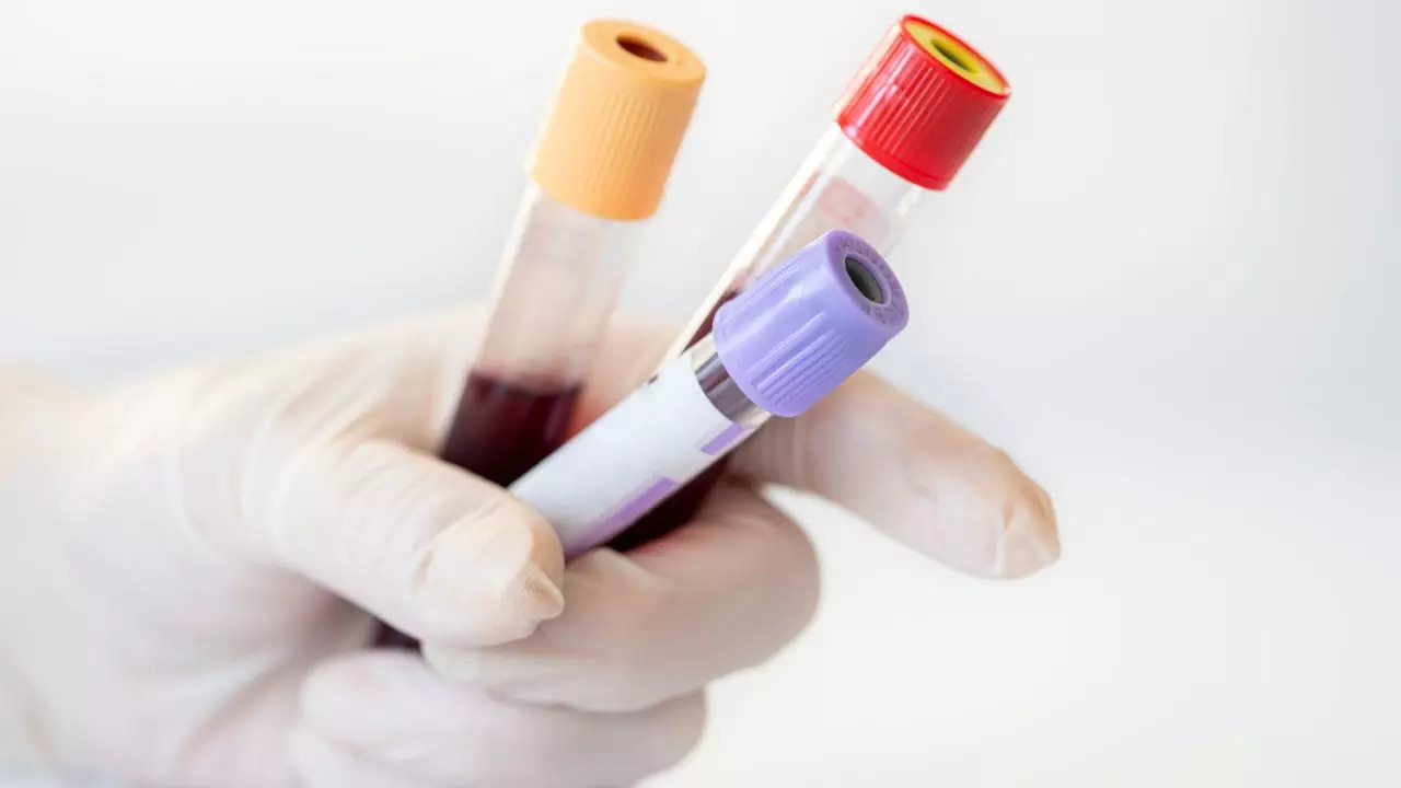 Blood test for Alzheimer's