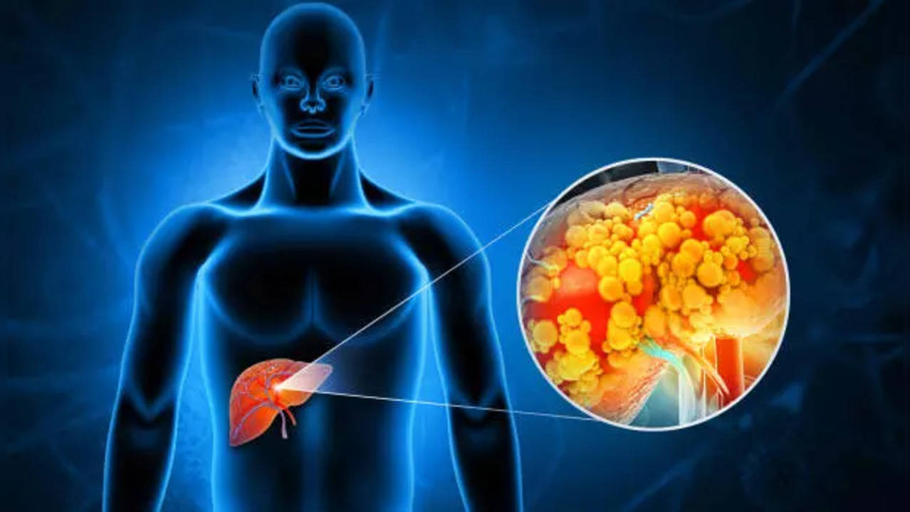 liver cancer