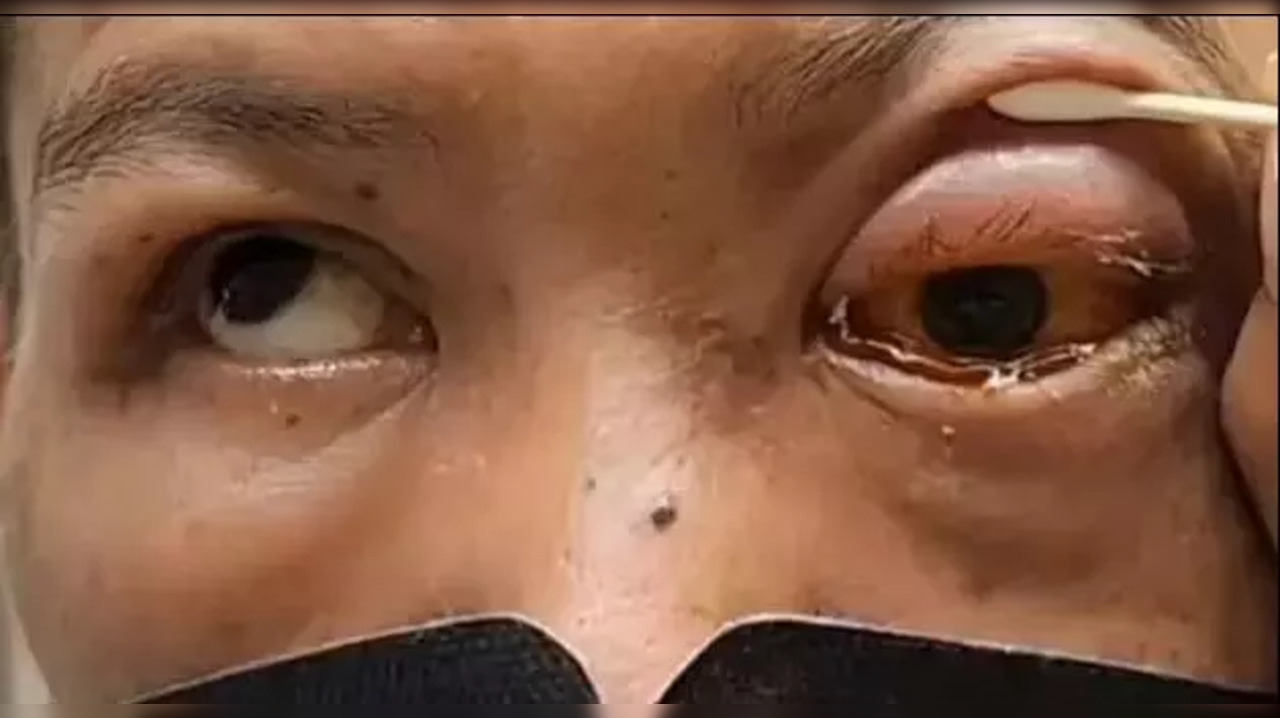 taiwanese man goes blind