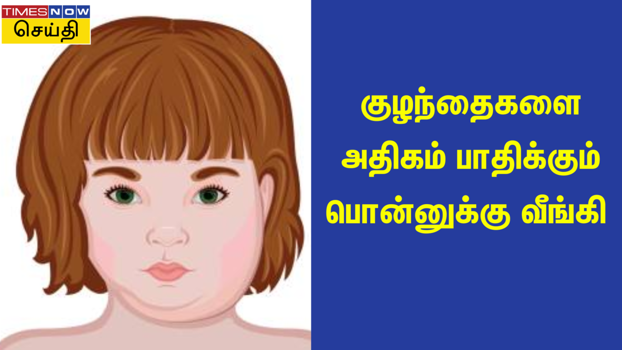 Mumps Spreading Among Children பொன்னுக்கு வீங்கி பற்றி தெரிந்து கொள்ள