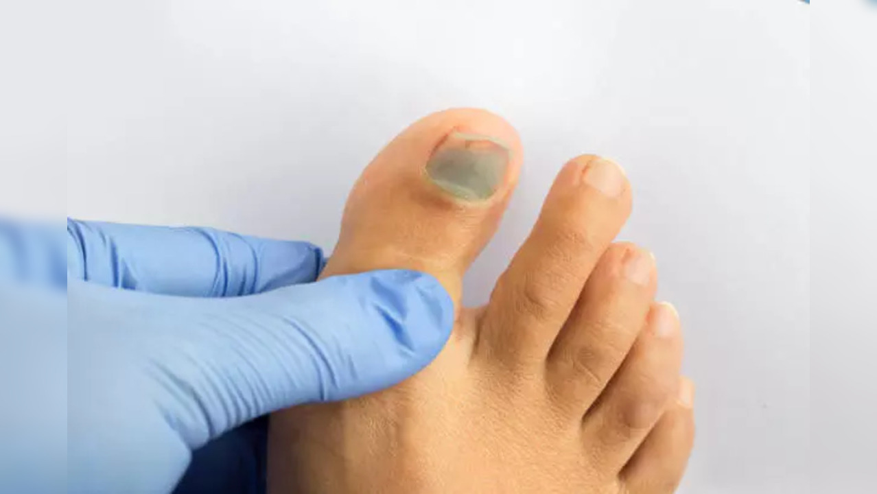 cholesterol on toenails