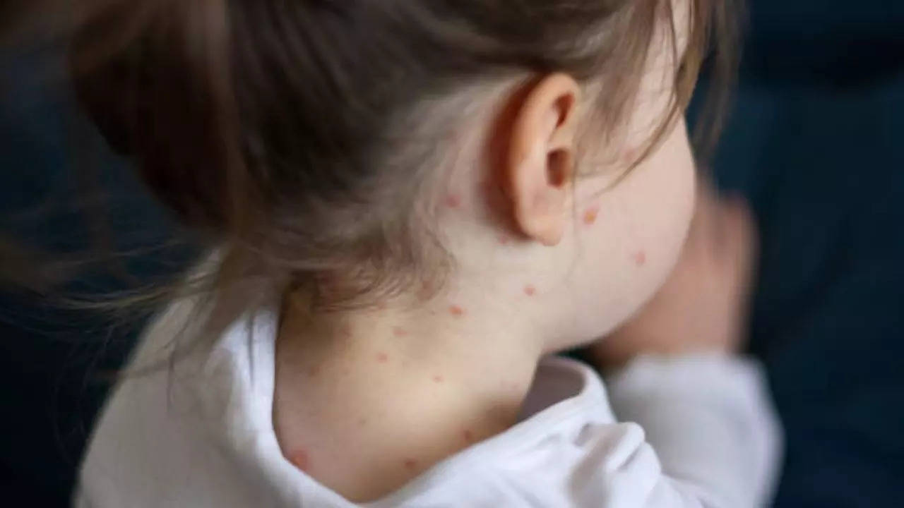 Measles Cases Trigger Alert in Australia