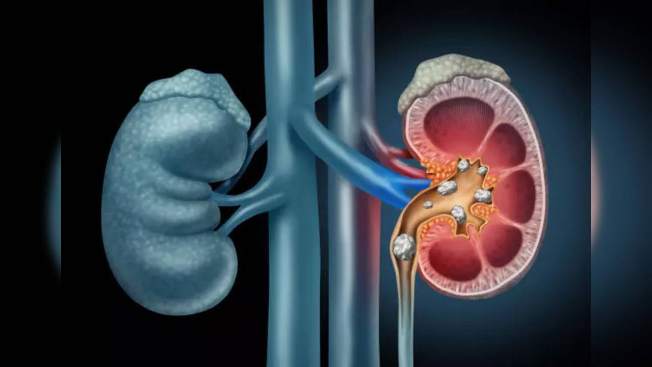 Beer for Kidney Stone: Does Beer Flush Out Kidney Stones? Expert Says ...