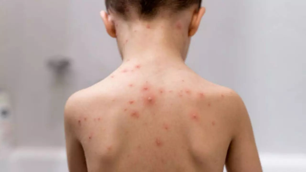 Chickenpox Outbreak- Check Symptoms And Preventive Measures