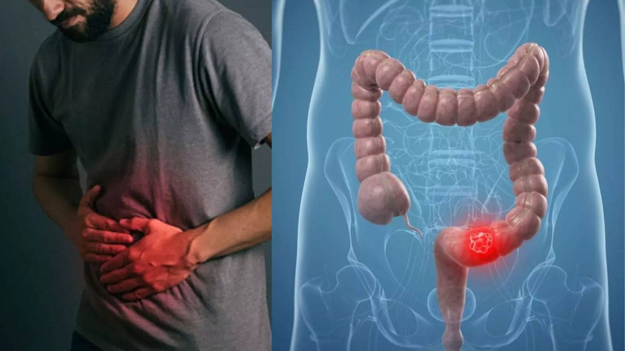 ​What Is Colon Cancer? Symptoms, Causes And More