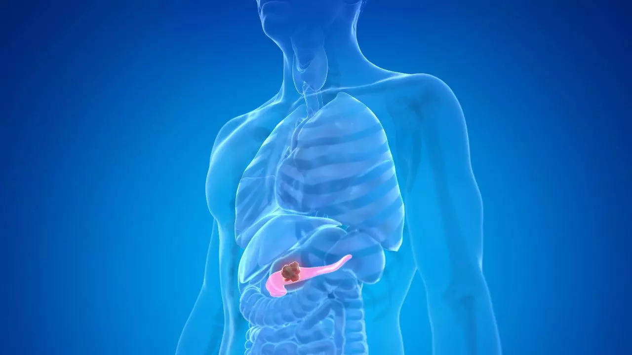 Pancreatic cancer