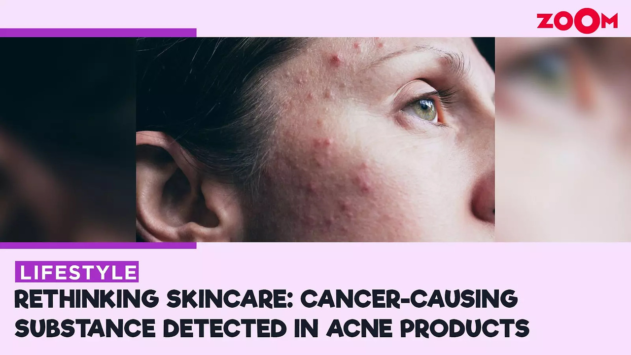 Benzene found in acne products: A cause for concern? | Times Now