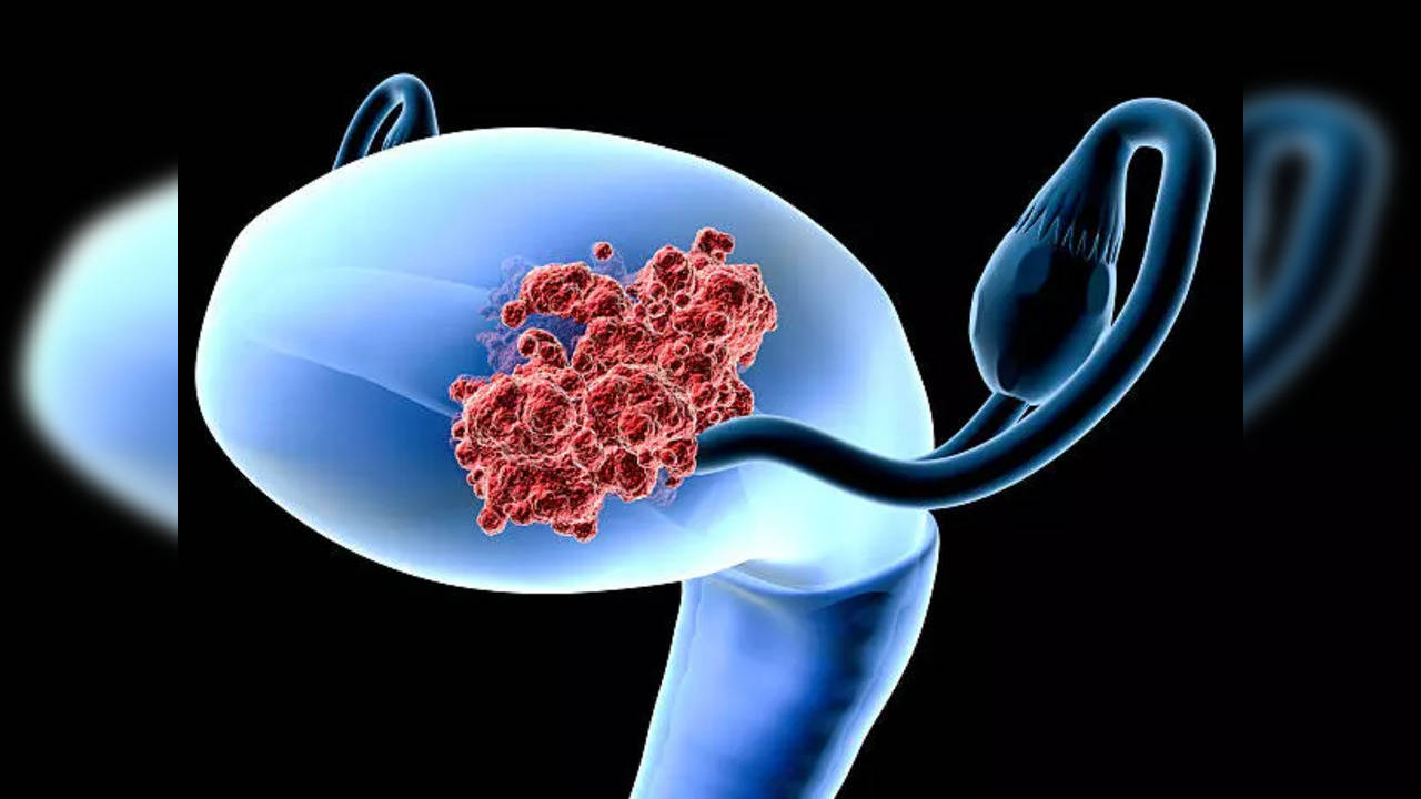 adenocarcinoma