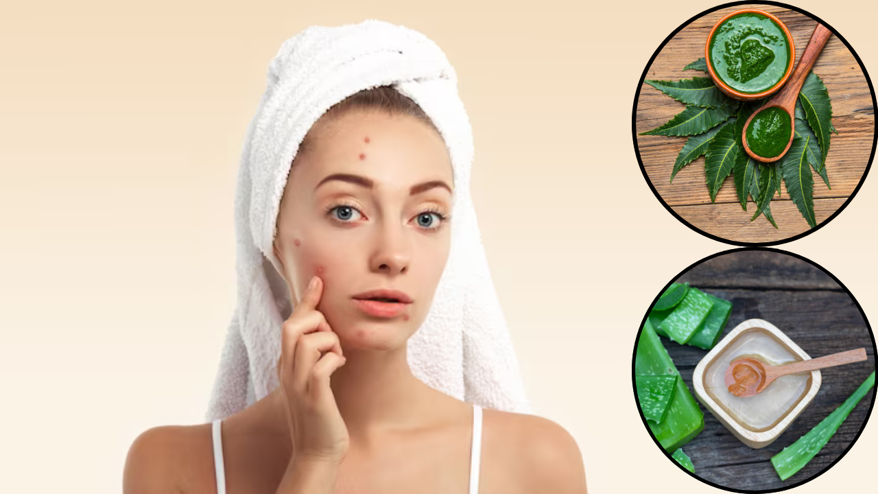 make diy face pack to get rid of pimple attack on face