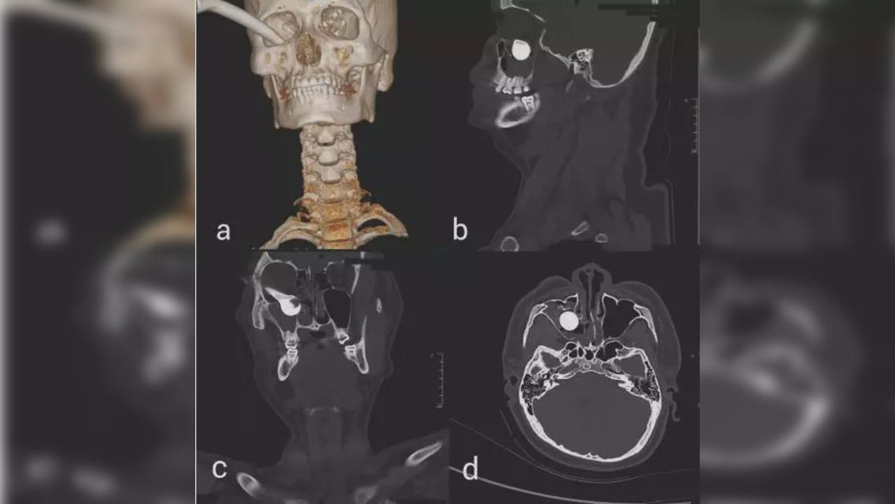 brake handle in teen's eye socket