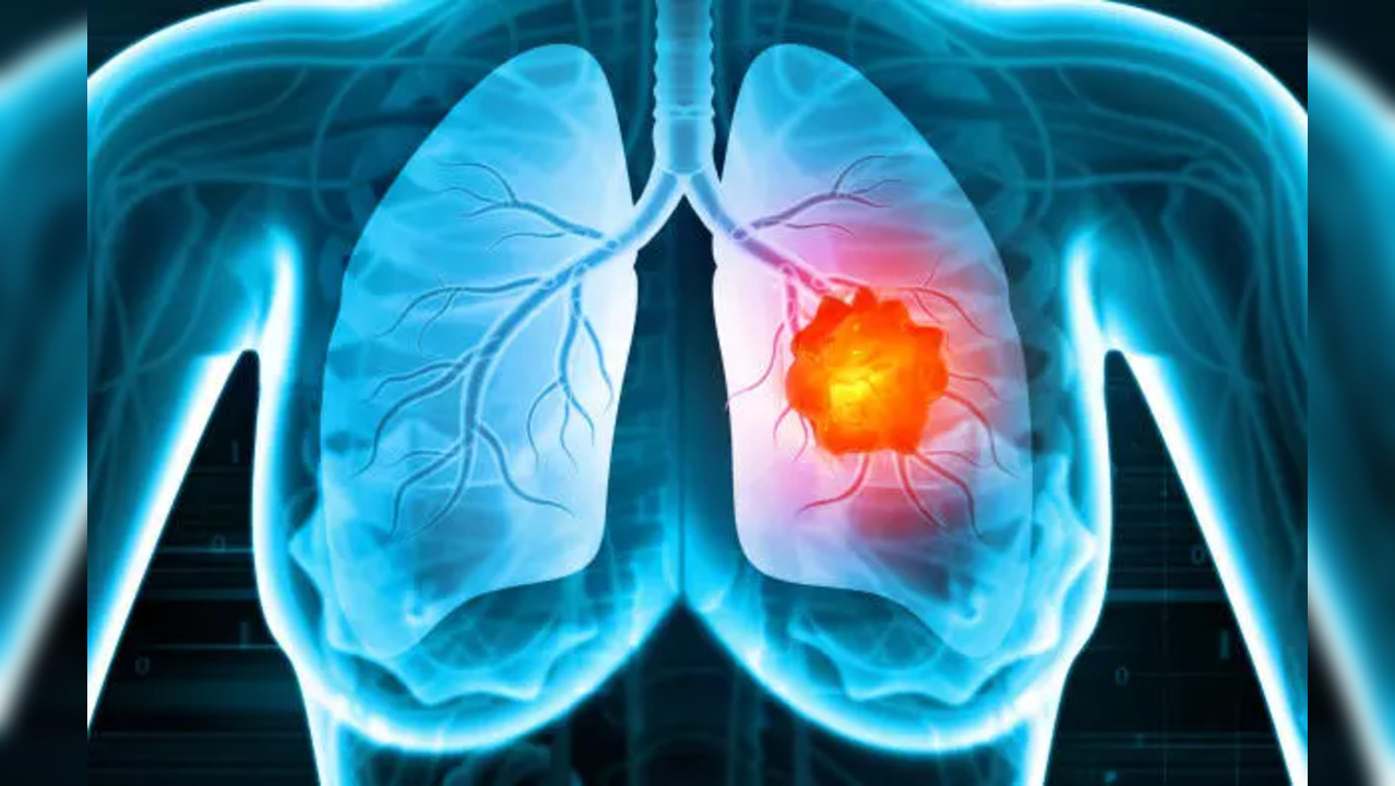 lung cancer