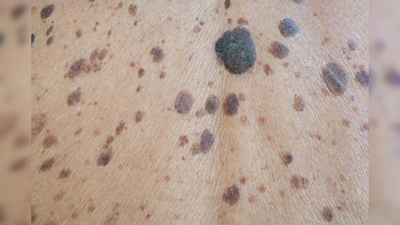 Acral melanoma