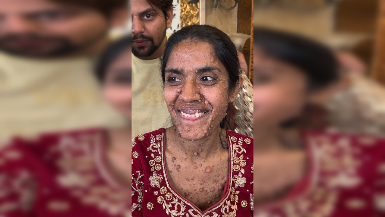 Viral Video: Bride With Face Spots Shares Tearful Journey From Rejections to Doctor's Embrace