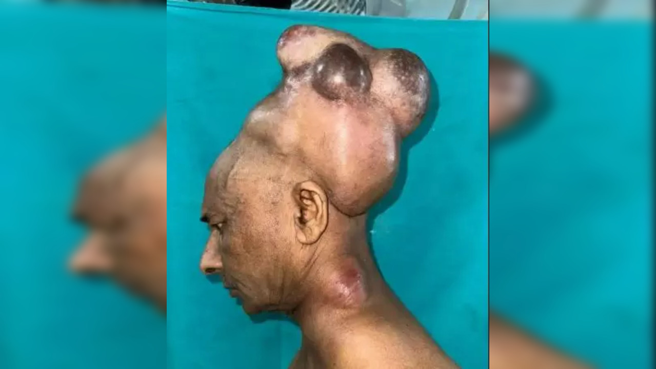 tumour on the head