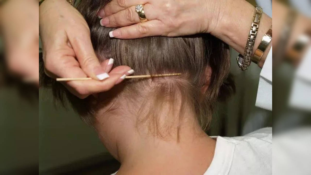 super lice on the rise in canada