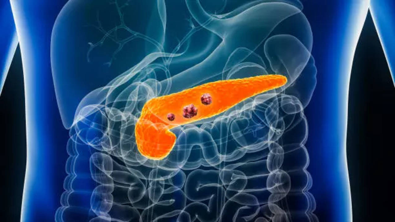 pancreatic cancer