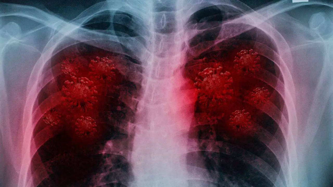 ‘Unusual’ Form Of Cell Death That Causes Lung Damage In COVID-19 Patients