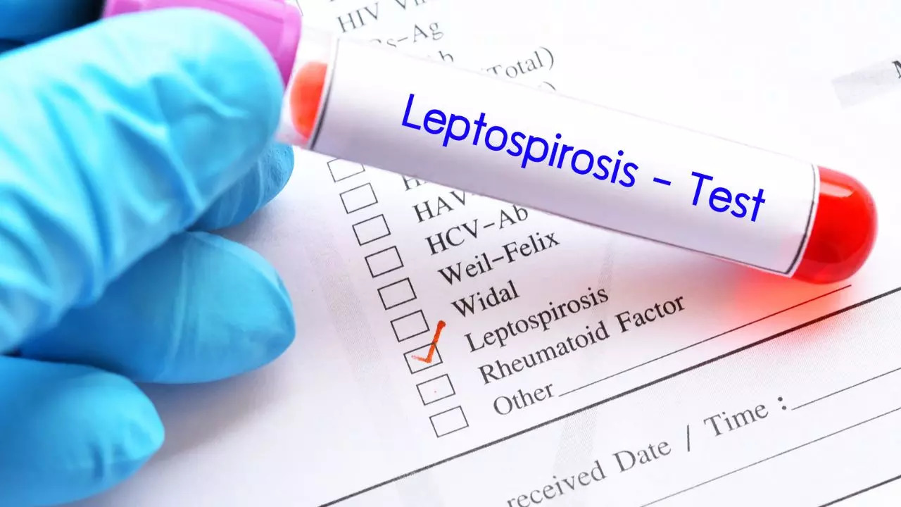 Leptospirosis: ​Know What Is Weil’s Disease That Severely Infected A Child After Swimming