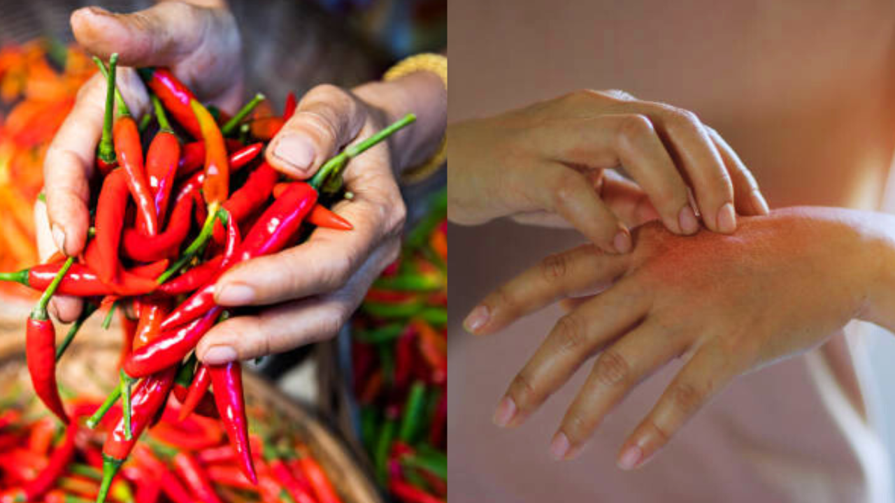 home remedies to get rid of hot pepper burn on the hands