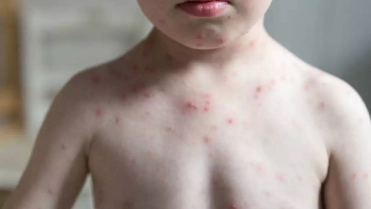 Chickenpox