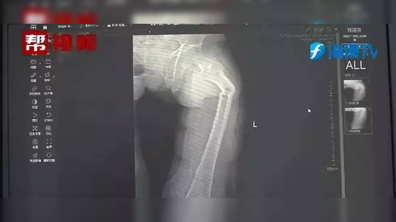 Chinese man breaks femur bone