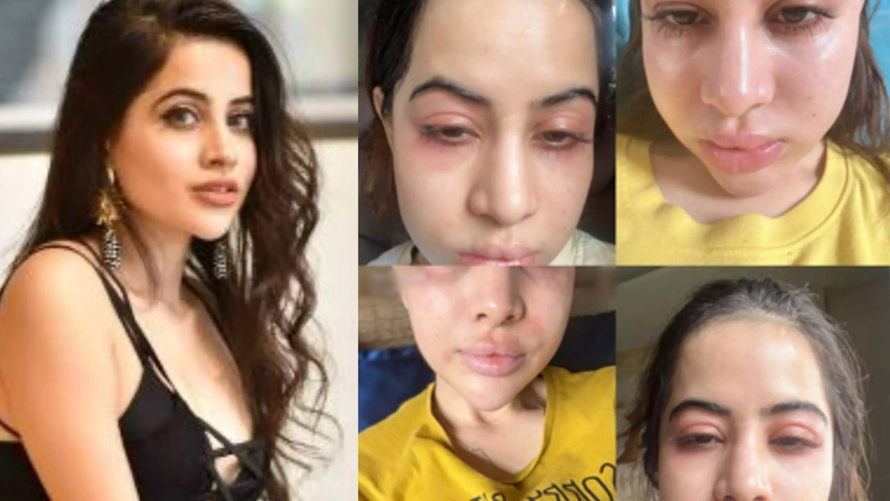 Urfi Javed's Reveals The Real Story Behind Her Swollen Face: 'Usual Fillers  And Botox...' | Times Now