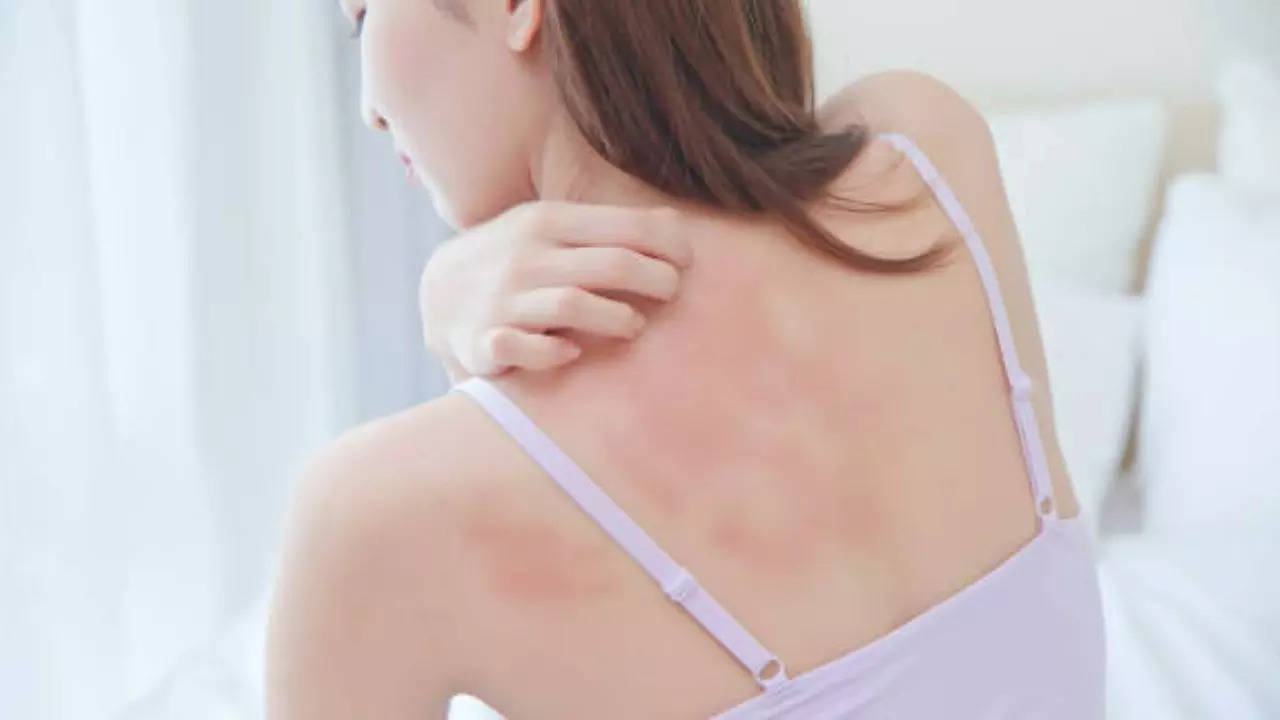 Salt flares up eczema