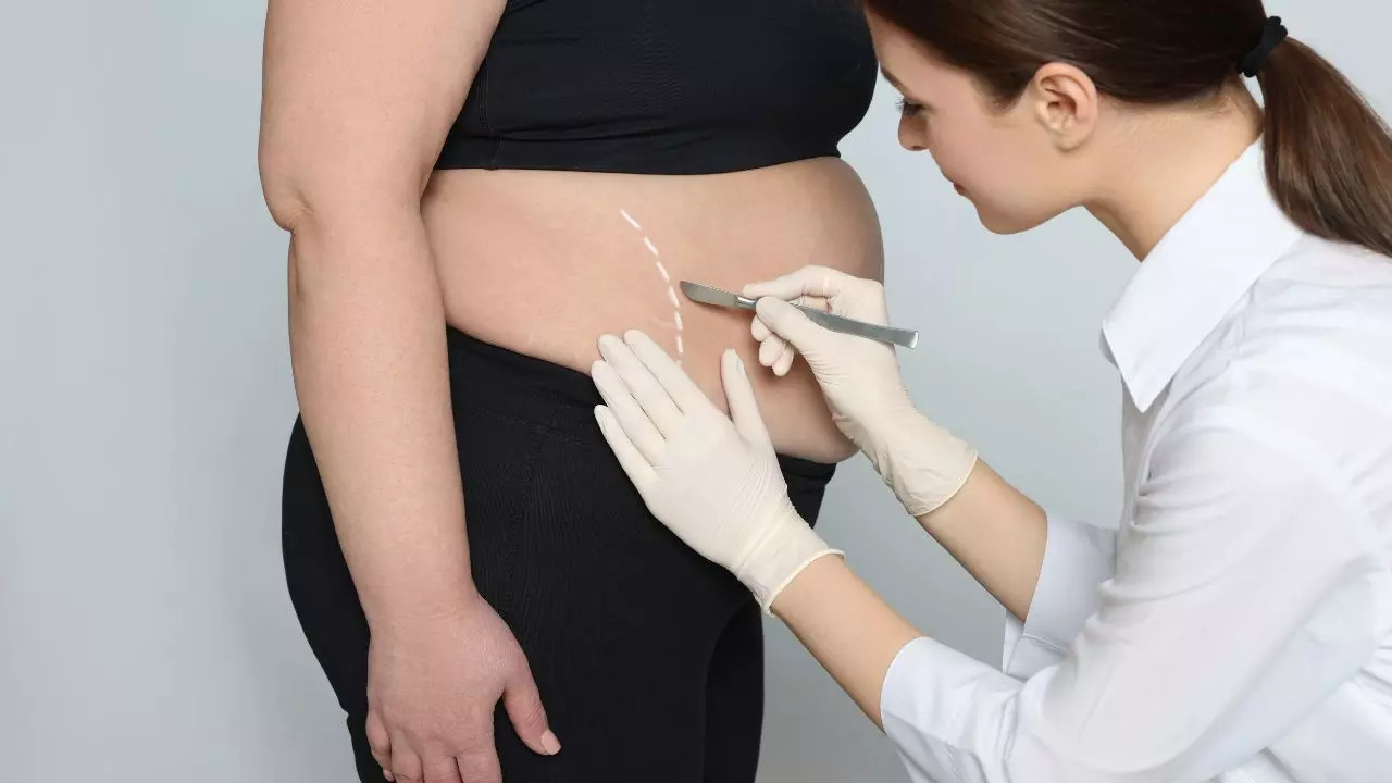 View of Bariatric Surgery For Type 2 Diabetes : Weight Loss Surgery Can Help ...