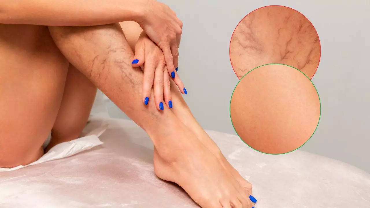 Doctor Shares Common Habits That Can Make Varicose Veins Worse