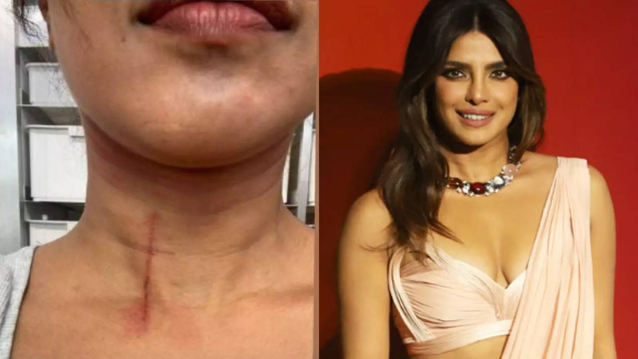 Priyanka Chopra Shares Glimpse Of 'Professional Hazards' As She Gets Injured During The Bluff Shoot