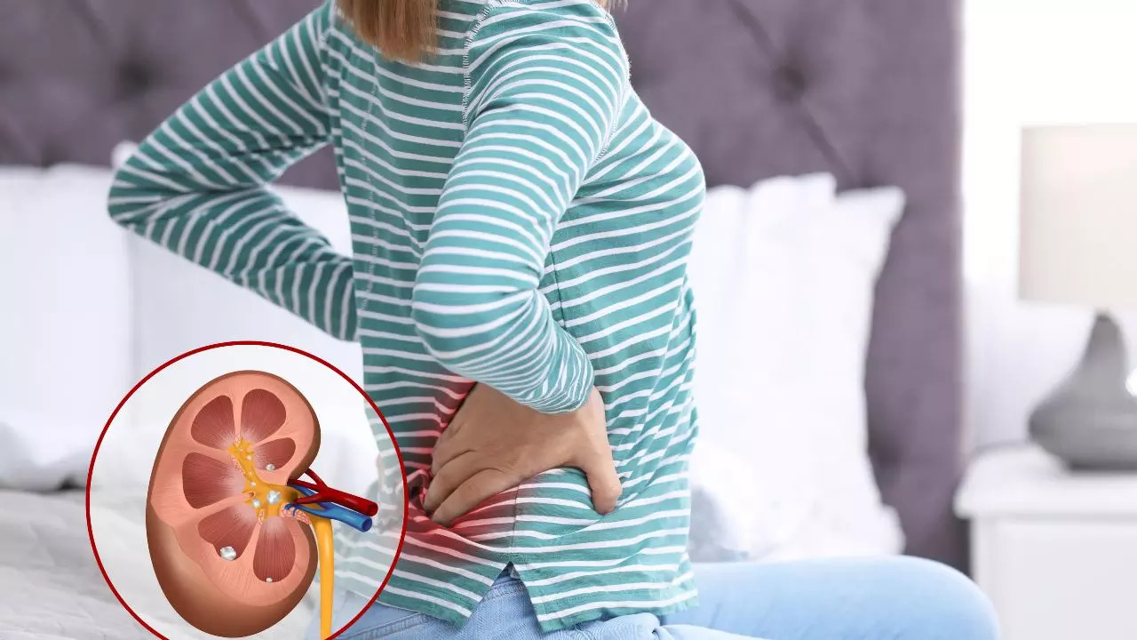 Home Remedies That Can Help Manage Kidney Stone Symptoms